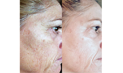 Hyperpigmentation