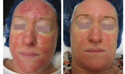 Rosacea