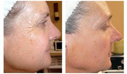 Aging Treatment