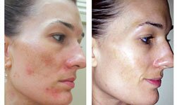 Melasma