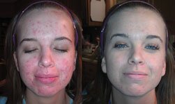 Acne Treatment