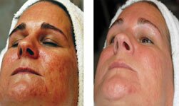 Rosacea
