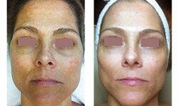 Melasma