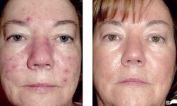Rosacea