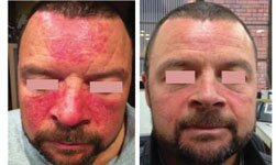 Rosacea