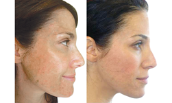 Hyperpigmentation