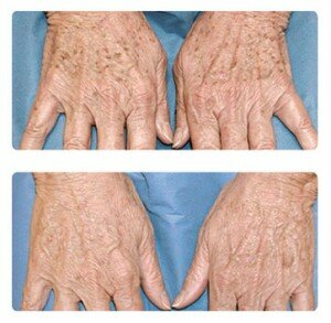 photorejuvenation_ba_02