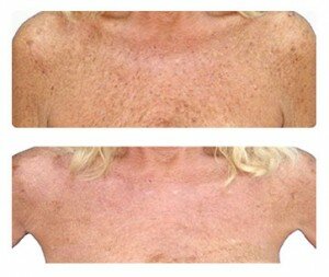 photorejuvenation_ba_03