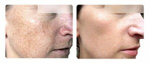 photorejuvenation_ba_04